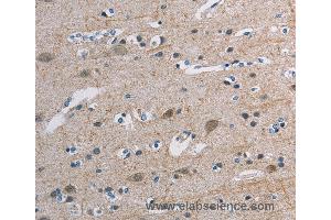 Immunohistochemistry of Human breast cancer using TONSL Polyclonal Antibody at dilution of 1:45 (NFKBIL2 anticorps)