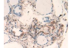 Detection of GAL2 in Human Thyroid Tissue using Polyclonal Antibody to Galectin 2 (GAL2) (Gallinacin-2 (GAL2) (AA 1-132) anticorps)