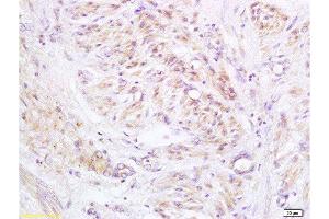 Formalin-fixed and paraffin embedded human cervical carcinoma labeled with Anti-PXMP1/ABCD3/PMP70 Polyclonal Antibody, Unconjugated  at 1:200 followed by conjugation to the secondary antibody and DAB staining.