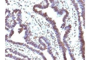 Formalin-fixed, paraffin-embedded human ovarian carcinoma stained with EMI1 antibody (EMI1/1176). (FBXO5 anticorps  (AA 1-250))