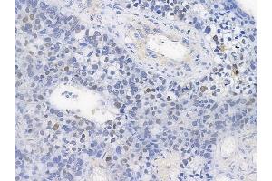 ABIN6254948 and ABIN6267278 at 1/100 staining human glioblastoma by IHC-P. (Estrogen Receptor alpha anticorps  (pSer118))