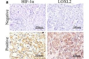 Expression of HIF-1α and LOXL2 correlates with vasculogenic mimicry (VM) and poor prognosis in HCC samples.