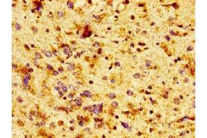 IHC image of ABIN7171423 diluted at 1:100 and staining in paraffin-embedded human glioma performed on a Leica BondTM system.