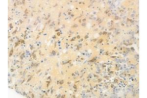 ABIN6255267 and ABIN6267477 at 1/100 staining human melanoma by IHC-P. (beta Catenin anticorps  (pSer37))