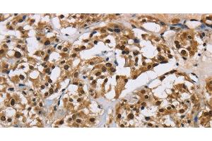 Immunohistochemistry of paraffin-embedded Human thyroid cancer using HNRNP L Polyclonal Antibody at dilution of 1:40 (HNRNPL anticorps)