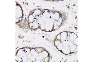 Immunohistochemistry of paraffin-embedded human gastric using MTDH antibody at dilution of 1:200 (40x lens). (MTDH anticorps)
