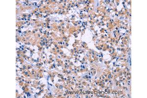 Immunohistochemistry of Human thyroid cancer using DUSP22 Polyclonal Antibody at dilution of 1:60 (DUSP22 anticorps)