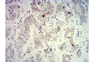 Immunohistochemical analysis of paraffin-embedded stomach cancer tissues using PCK2 mouse mAb with DAB staining.