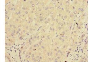 Immunohistochemistry of paraffin-embedded human liver cancer using ABIN7165964 at dilution of 1:100 (PPM1M anticorps  (AA 1-247))