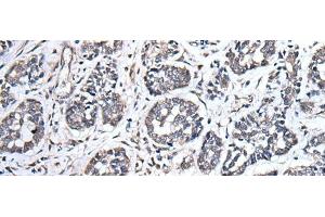Immunohistochemistry of paraffin-embedded Human esophagus cancer tissue using UBE2E3 Polyclonal Antibody at dilution of 1:40(x200) (UBE2E3 anticorps)