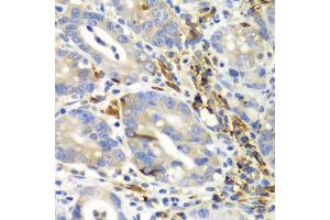 Immunohistochemistry of paraffin-embedded human gastric cancer using AIMP1 antibody. (AIMP1 anticorps)
