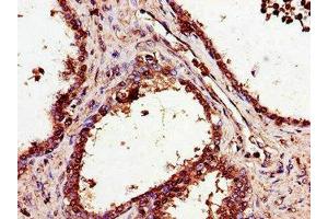 Immunohistochemistry of paraffin-embedded human prostate cancer using ABIN7170549 at dilution of 1:100 (SMS anticorps  (AA 16-191))