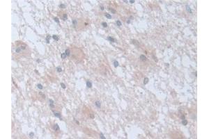 Detection of RARa in Human Glioma Tissue using Polyclonal Antibody to Retinoic Acid Receptor Alpha (RARa)