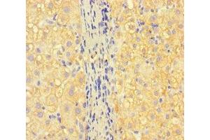 Immunohistochemistry of paraffin-embedded human liver cancer using ABIN7157130 at dilution of 1:100 (ISPD anticorps  (AA 1-264))