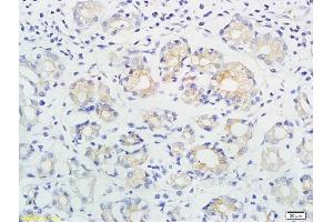 Formalin-fixed and paraffin embedded human gastric cancer labeled with Anti-ING1/p33 Polyclonal Antibody, Unconjugated (ABIN674514) followed by conjugation to the secondary antibody and DAB staining (ING1 anticorps  (AA 301-422))