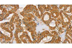 Immunohistochemistry of paraffin-embedded Human thyroid cancer tissue using PDP1 Polyclonal Antibody at dilution 1:30 (PDP anticorps)