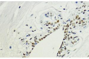 Immunohistochemistry of paraffin-embedded Human breast using DiMethyl-Histone H3-K36 Polyclonal Antibody at dilution of 1:200 (40x lens). (Histone 3 anticorps  (2meLys36))