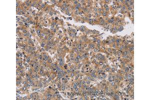 Immunohistochemistry of Human colon cancer using KCNG1 Polyclonal Antibody at dilution of 1:40 (KCNG1 anticorps)