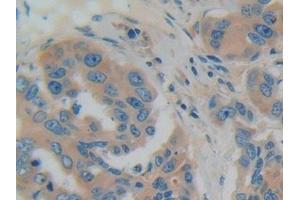 Detection of GDI1 in Human Breast cancer Tissue using Polyclonal Antibody to GDP Dissociation Inhibitor 1 (GDI1) (GDI1 anticorps  (AA 1-274))