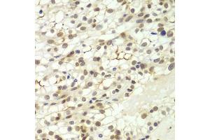 Immunohistochemistry of paraffin-embedded human kidney cancer using LHX4 antibody (ABIN6128183, ABIN6143193, ABIN6143194 and ABIN6224097) at dilution of 1:100 (40x lens).