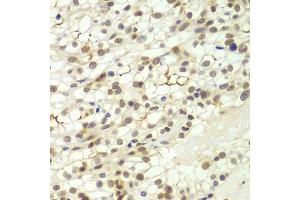 Immunohistochemistry of paraffin-embedded human kidney cancer using LHX4 antibody (ABIN6128183, ABIN6143193, ABIN6143194 and ABIN6224097) at dilution of 1:100 (40x lens). (LHX4 anticorps  (AA 121-390))