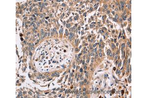 Immunohistochemistry of Human lung cancer using FUCA1 Polyclonal Antibody at dilution of 1:30 (FUCA1 anticorps)