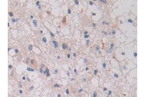 Detection of ITGb1 in Human Glioma Tissue using Polyclonal Antibody to Integrin Beta 1 (ITGb1)