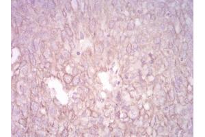 Immunohistochemical analysis of paraffin-embedded ovarian cancer tissues using CK5 mouse mAb with DAB staining.