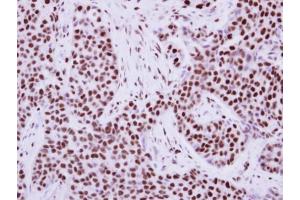 IHC-P Image Immunohistochemical analysis of paraffin-embedded human breast cancer, using KAP1, antibody at 1:500 dilution. (KAP1 anticorps)