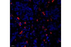 Immunofluorescence of paraffin embedded human esophagus cancer using c-caspase3 (ABIN7073336) at dilution of 1:500 (400x lens)
