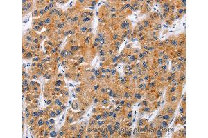 Immunohistochemistry of Human gastric cancer using TNFRSF9 Polyclonal Antibody at dilution of 1:50 (CD137 anticorps)