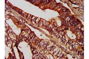 IHC image of ABIN7170916 diluted at 1:300 and staining in paraffin-embedded human colon cancer performed on a Leica BondTM system.