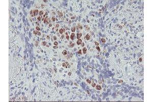 Immunohistochemical staining of paraffin-embedded Carcinoma of Human lung tissue using anti-ACSF2 mouse monoclonal antibody. (ACSF2 anticorps)