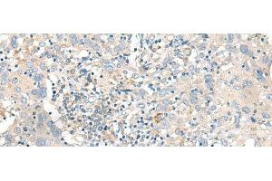 Immunohistochemistry of paraffin-embedded Human cervical cancer tissue using GART Polyclonal Antibody at dilution of 1:30(x200) (GART anticorps)