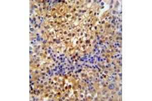 Formalin fixed and paraffin embedded human cervix carcinoma reacted with PRPF38A Antibody (C-term) followed by peroxidase conjugation of the secondary antibody and DAB staining