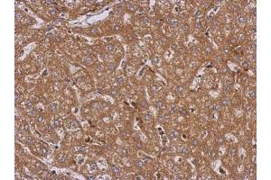 IHC-P Image Immunohistochemical analysis of paraffin-embedded human hepatoma, using LRRN2, antibody at 1:500 dilution.