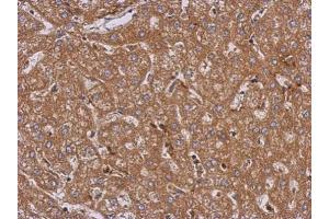IHC-P Image Immunohistochemical analysis of paraffin-embedded human hepatoma, using LRRN2, antibody at 1:500 dilution. (LRRN2 anticorps)