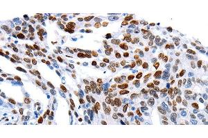 Immunohistochemistry of paraffin-embedded Human ovarian cancer using MUTYH Polyclonal Antibody at dilution of 1:60 (MUTYH anticorps)