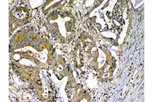 IHC testing of FFPE human rectal cancer tissue with CFD antibody at 1ug/ml.