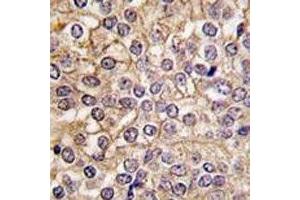 IHC analysis of FFPE human prostate carcinoma tissue stained with IL1R1 antibody (IL1R1 anticorps  (AA 474-503))