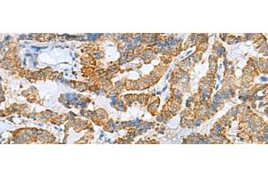 Immunohistochemistry of paraffin-embedded Human thyroid cancer tissue using FBXO8 Polyclonal Antibody at dilution of 1:40(x200) (FBXO8 anticorps)