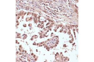 Immunohistochemistry of paraffin-embedded human lung cancer using Rad50 antibody (ABIN3017329, ABIN3017330, ABIN3017331 and ABIN6220043) at dilution of 1:100 (40x lens).