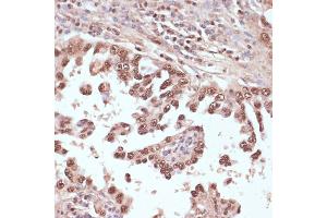 Immunohistochemistry of paraffin-embedded human lung cancer using Rad50 antibody (ABIN3017329, ABIN3017330, ABIN3017331 and ABIN6220043) at dilution of 1:100 (40x lens). (RAD50 anticorps  (AA 1-100))