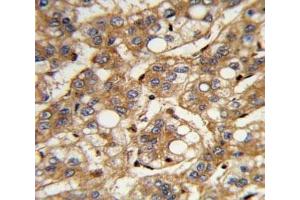 IHC analysis of FFPE human hepatocarcinoma with IFNB1 antibody