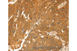 Immunohistochemistry of Human breast cancer using TMEFF2 Polyclonal Antibody at dilution of 1:35 (TMEFF2 anticorps)
