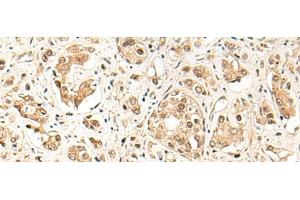 Immunohistochemistry of paraffin-embedded Human prost ate cancer tissue using GPR139 Polyclonal Antibody at dilution of 1:50(x200) (GPR139 anticorps)