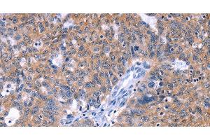 Immunohistochemistry of paraffin-embedded Human ovarian cancer tissue using ZNF395 Polyclonal Antibody at dilution 1:40 (ZNF395 anticorps)