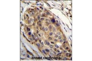 SSH3 Antibody (C-term) (ABIN655643 and ABIN2845120) immunohistochemistry analysis in formalin fixed and paraffin embedded human breast carcinoma followed by peroxidase conjugation of the secondary antibody and DAB staining. (SSH3 anticorps  (C-Term))