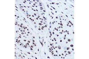 Immunohistochemistry of paraffin-embedded human esophageal cancer using SSB Rabbit pAb (ABIN3015264, ABIN3015265, ABIN3015266 and ABIN6213909) at dilution of 1:300 (40x lens). (SSB anticorps  (AA 166-408))