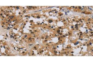 Immunohistochemistry of paraffin-embedded Human thyroid cancer tissue using E2F4 Polyclonal Antibody at dilution 1:40